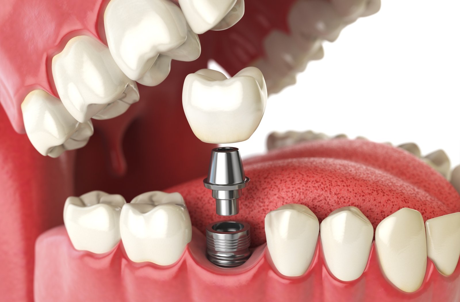 A 3D illustration of a dental implant placement