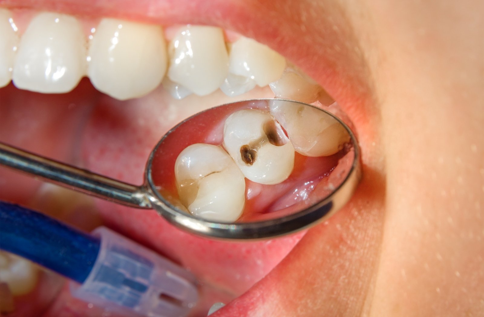 A close-up view of a dentist using a small handheld mirror to better view a cavity