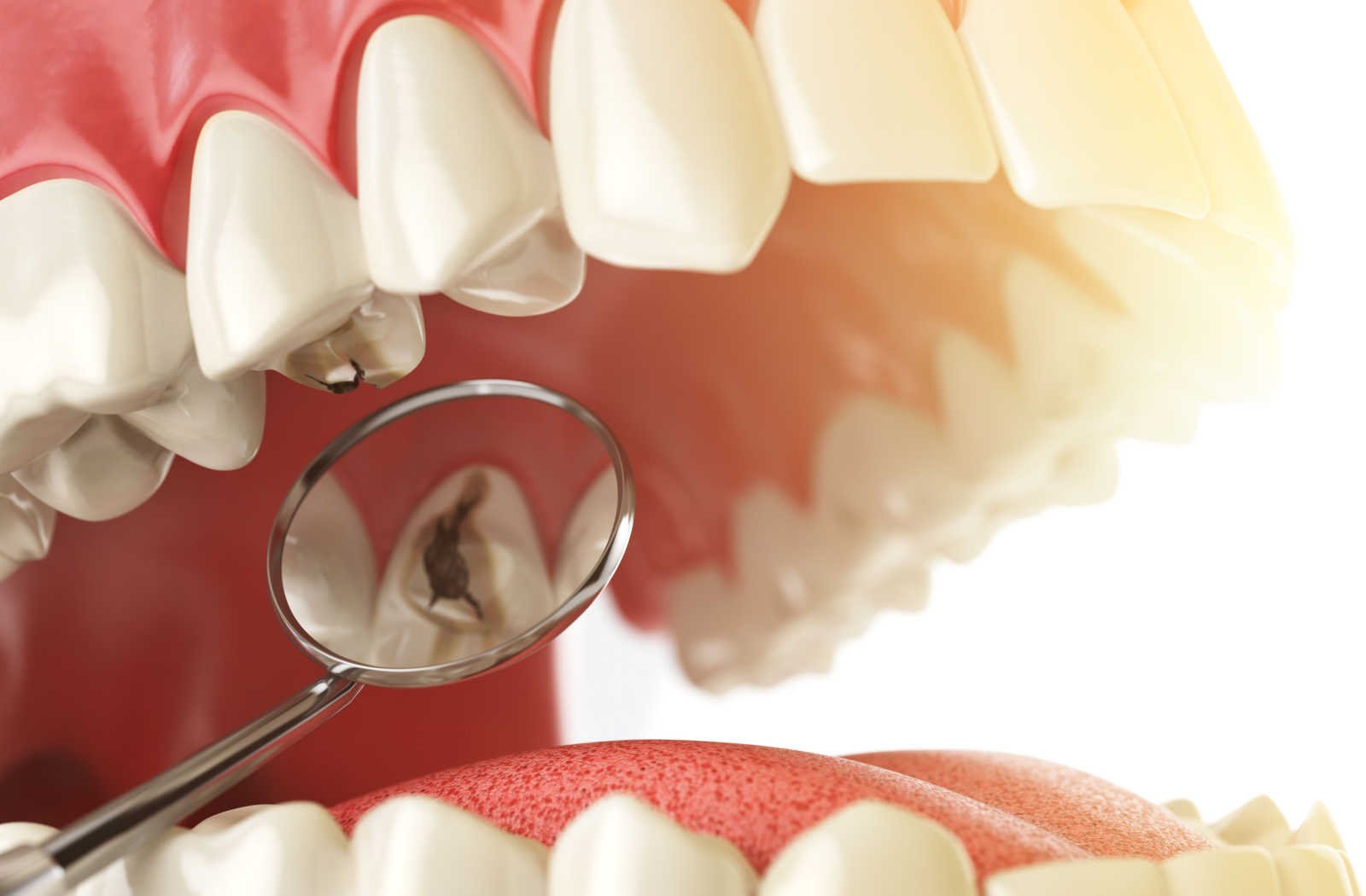 A dentist uses a dental mirror used to reveal the cavity on a tooth in the upper denture.
