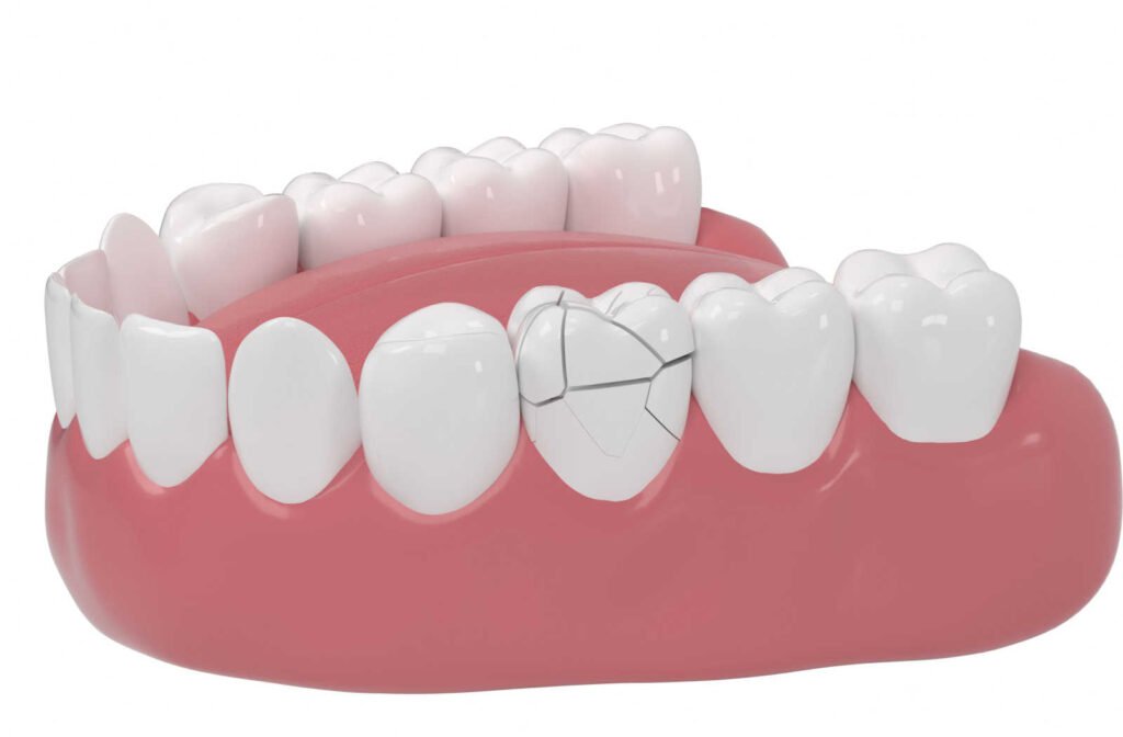 A 3D image of a denture to show a cracked tooth.